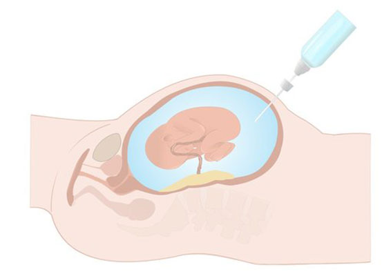 Amniocentesis_CVS